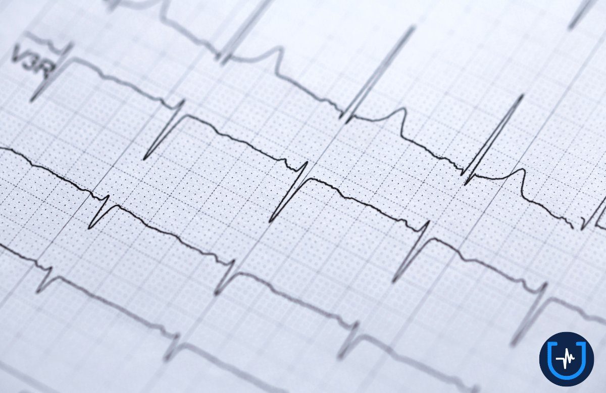Trazado de electrocardiograma